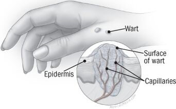 The structure of the wart on the hand. 
