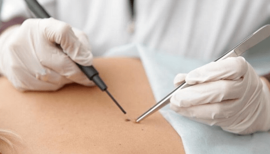 Characteristics of the removal of papilloma
