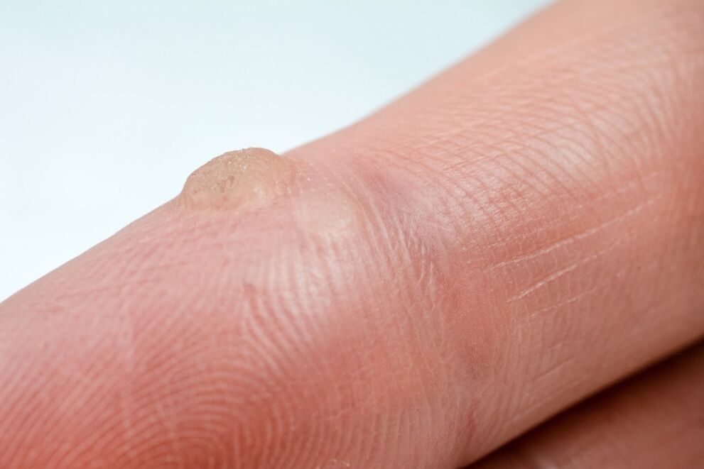 wart