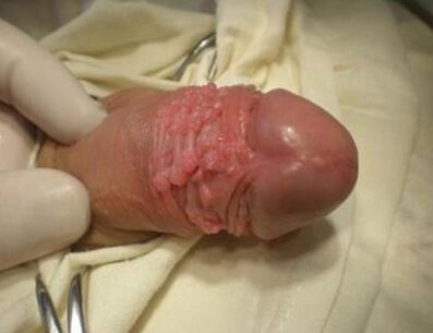 Papilloma in a member
