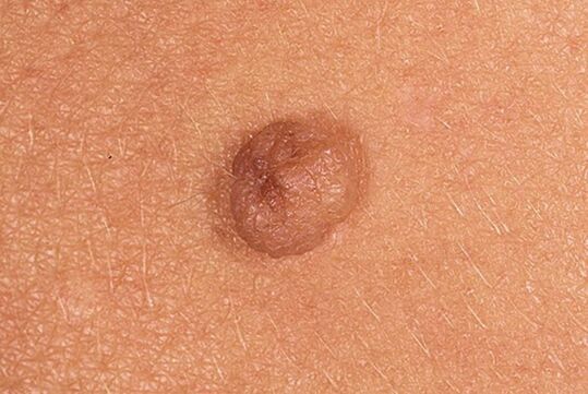 Simple papilloma