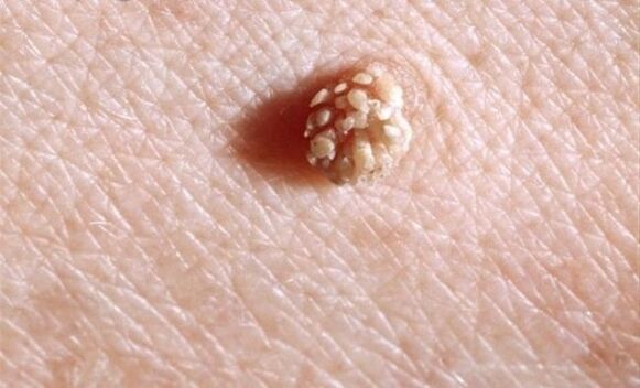 Papilloma in the human body