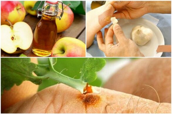 home remedies for warts
