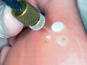 Cryodestruction as a method of removing plantar warts.