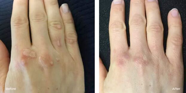 successful removal of warts after using Rimovio gel Andrew's review 2